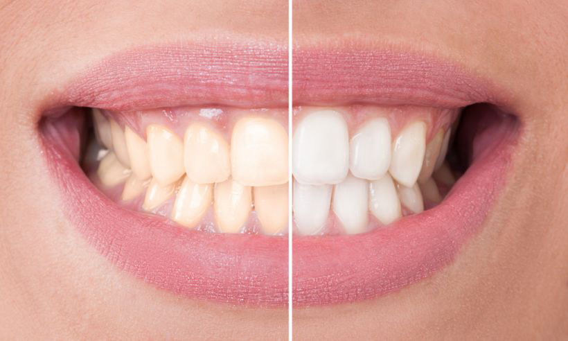 Combo Clareamento Dental + tratamento ortodôntico